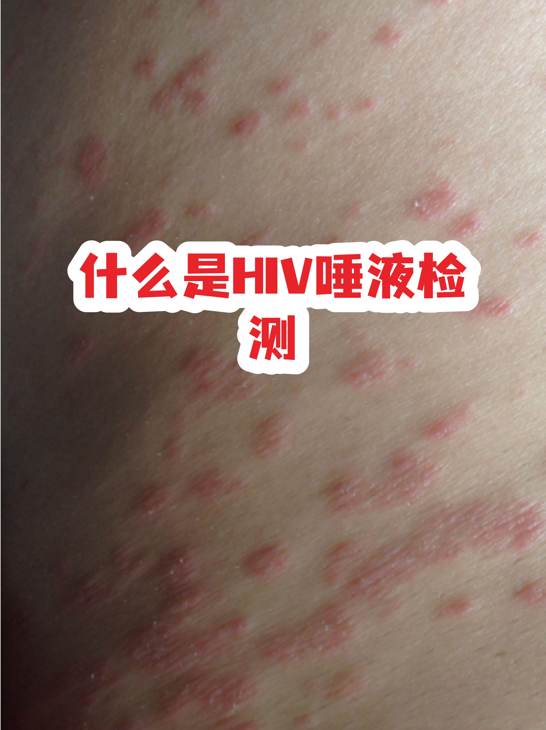 艾滋病第四代检测是抽血吗 艾滋病第四代检测是抽血吗