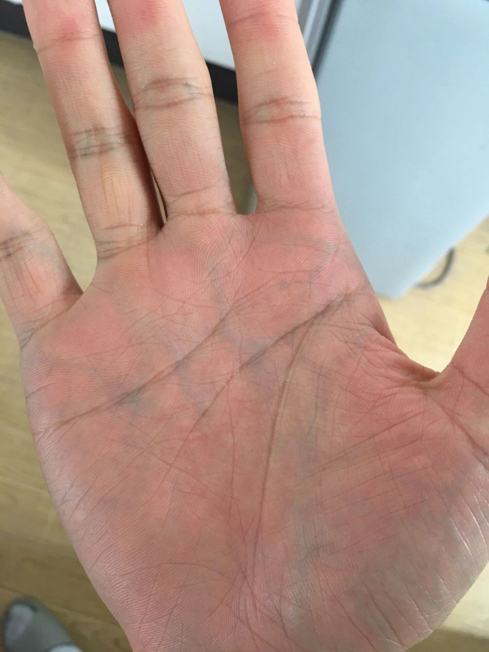 手掌血管发青 手掌血管明显是心脏问题还是贫血体虚?