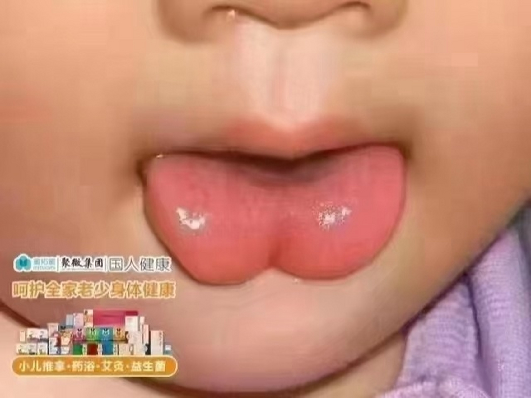 小儿舌诊案例:舌尖缺损(w型舌) 心血不足:1:心脏发育不全2:心脏功能弱