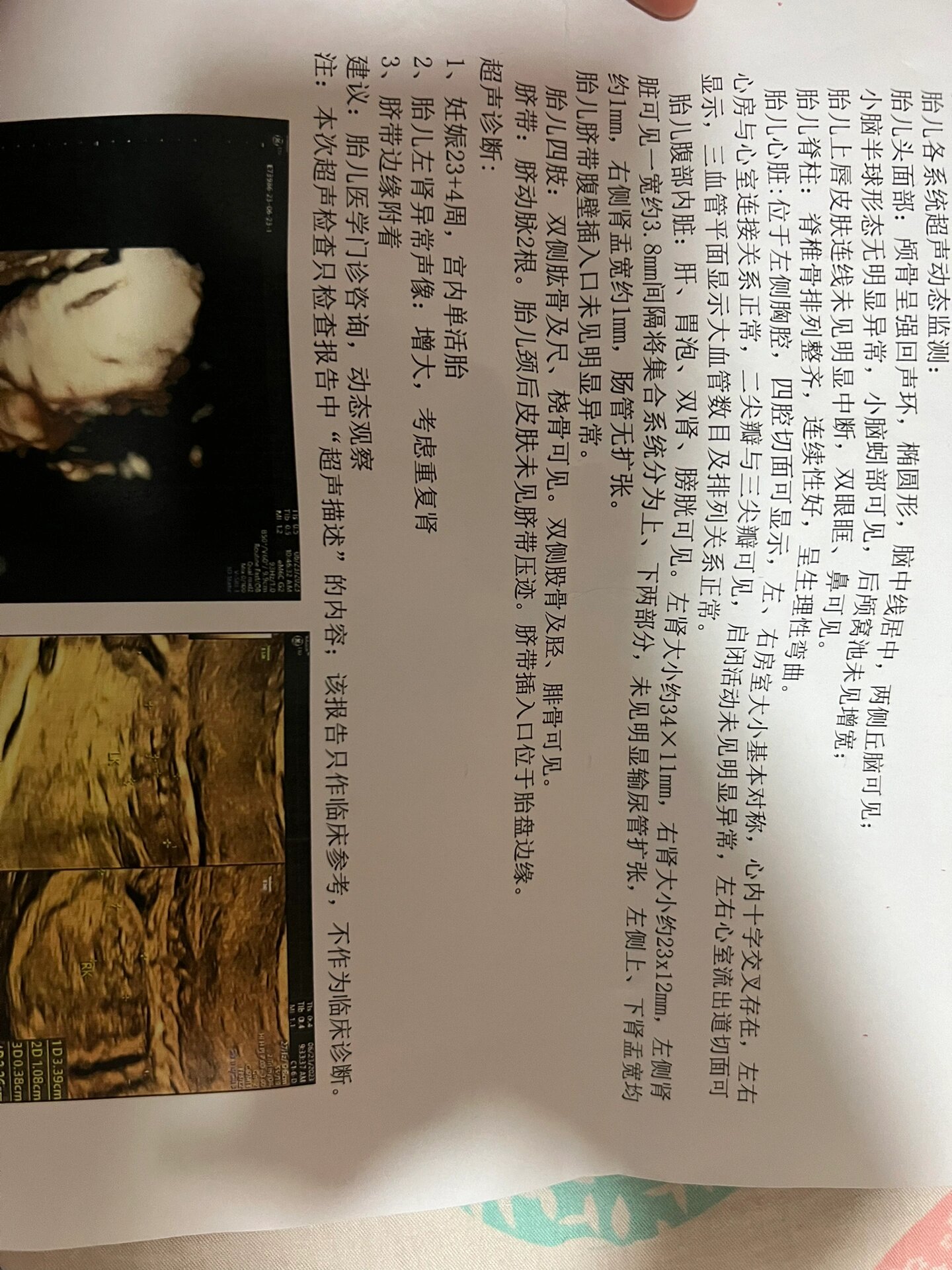宝宝确诊是左肾双肾盂,希望有奇迹出现05 今天去省三级医院复查了