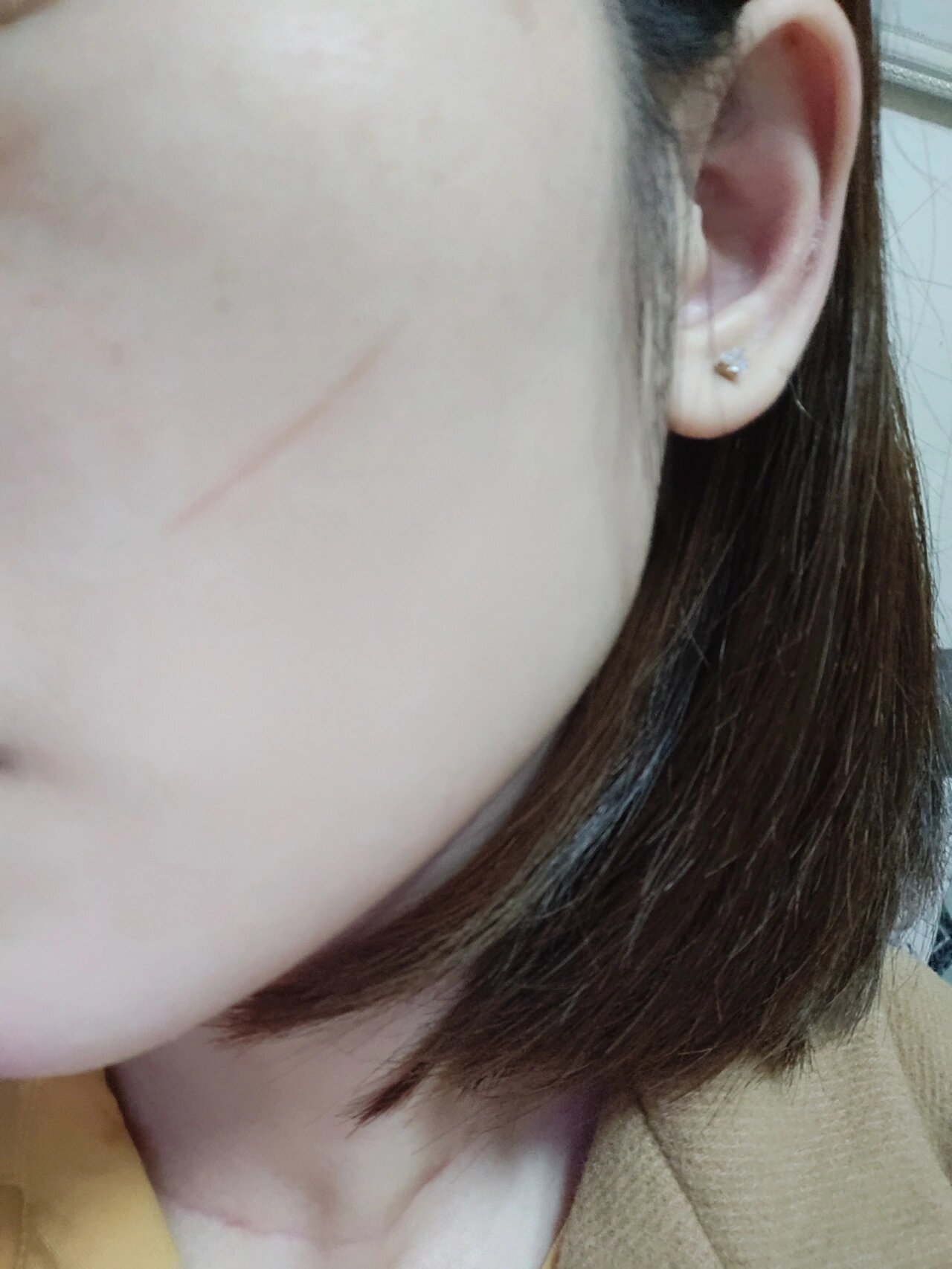 指甲抓伤一个月了,留下一条印子,怎么办