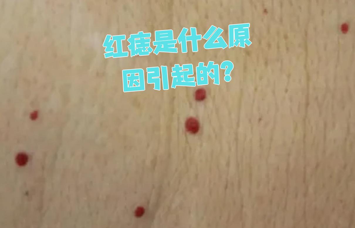 红痣也叫樱桃状血管瘤,主要是因为皮肤毛细血管增生或内皮细胞出了