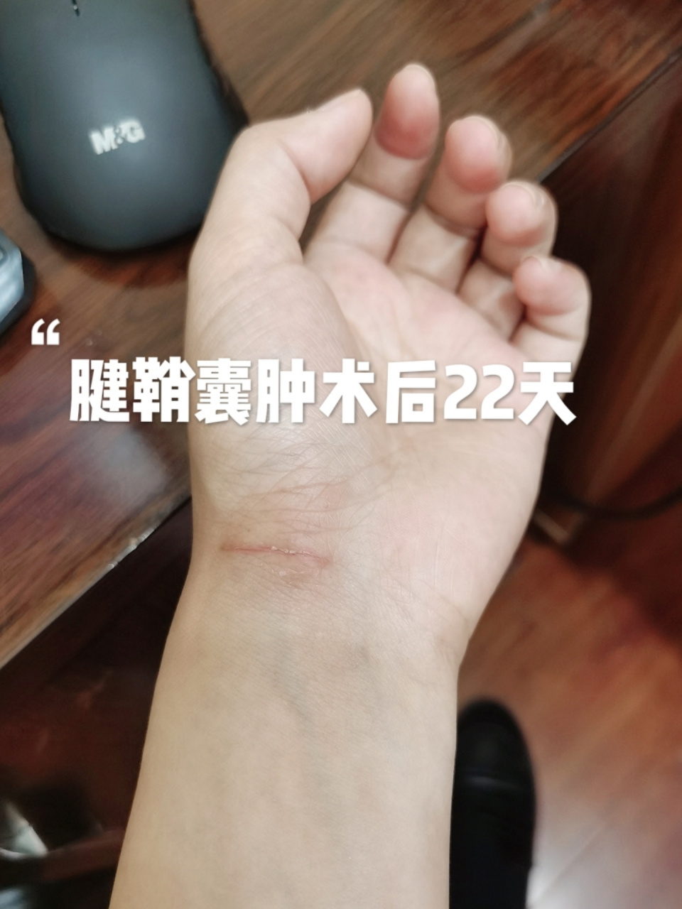 腱鞘囊肿术后恢复 伤口已经愈合了,最近开始可以骑电动车,拿一些不重