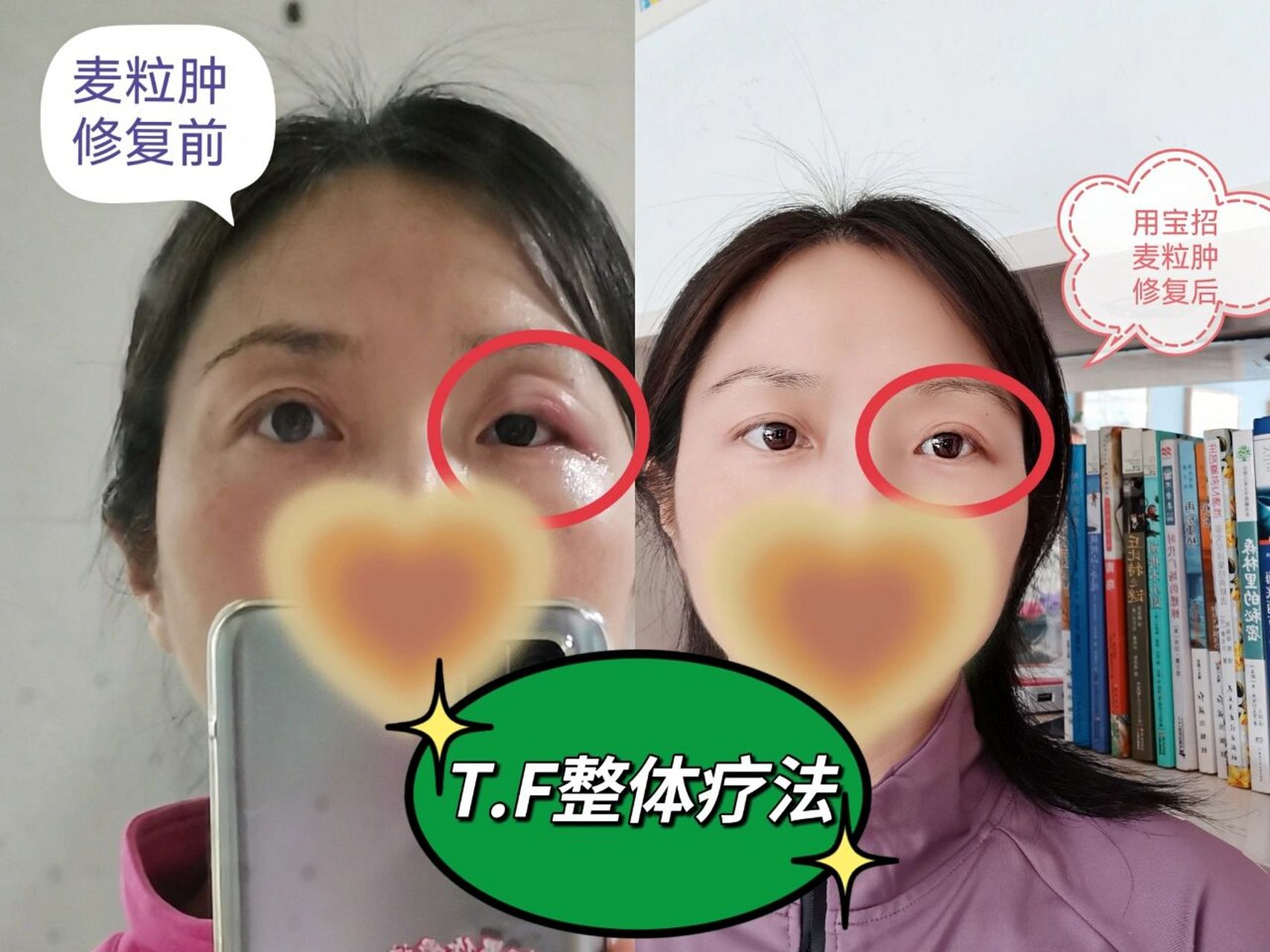 "麦粒肿"俗称"偷眼针". 意思是偷看了不该看的事物.