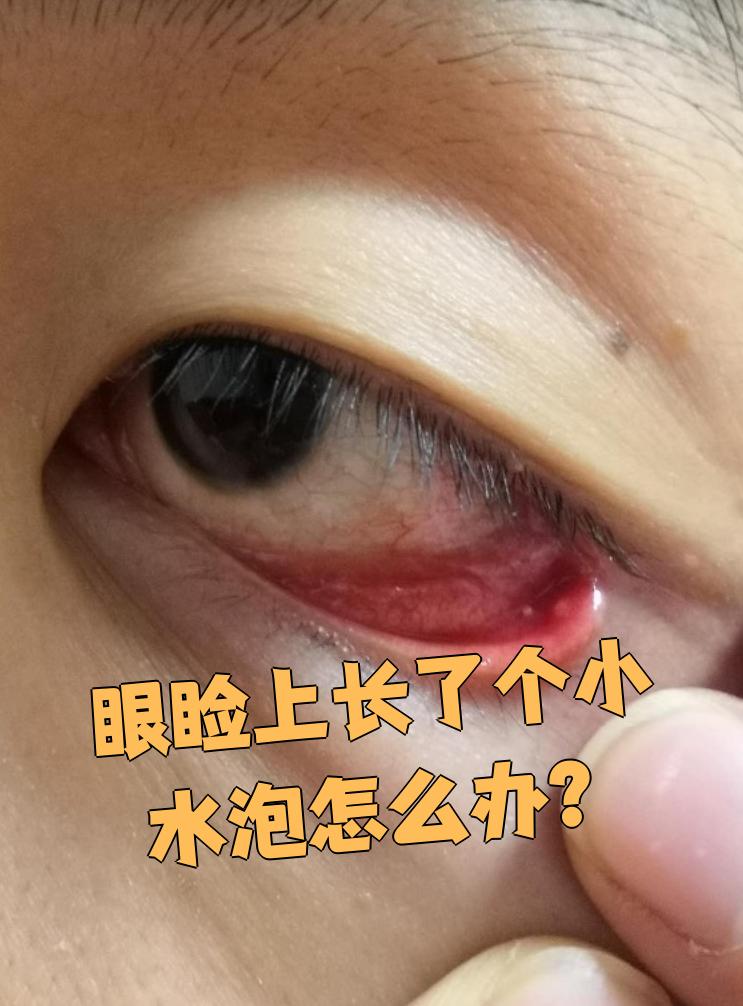 眼睑长小水泡可能由多种原因引起,常见的有接触性皮炎,单纯疱疹