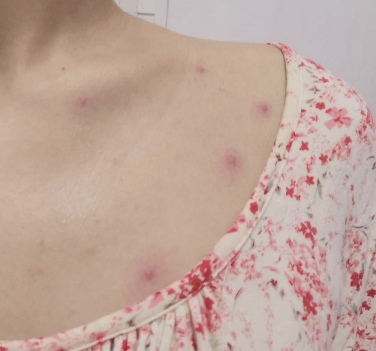 水痘结痂不小心碰掉了一般不会留疤,但要看伤口的具体情况