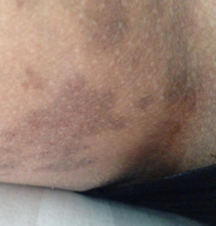 腹股沟皮肤发黑可能是正常现象,也可能是疾病引起的