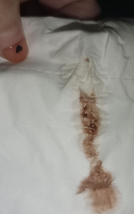 小学生女生内裤出现褐色分泌物,常见原因有四个,需要根据具体情况