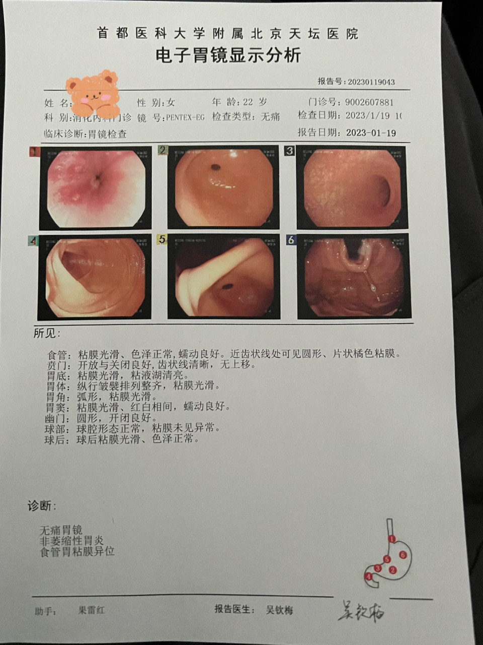 无痛胃镜当日报告 报告结果写的非萎缩性胃炎,食管胃黏膜异位,也不
