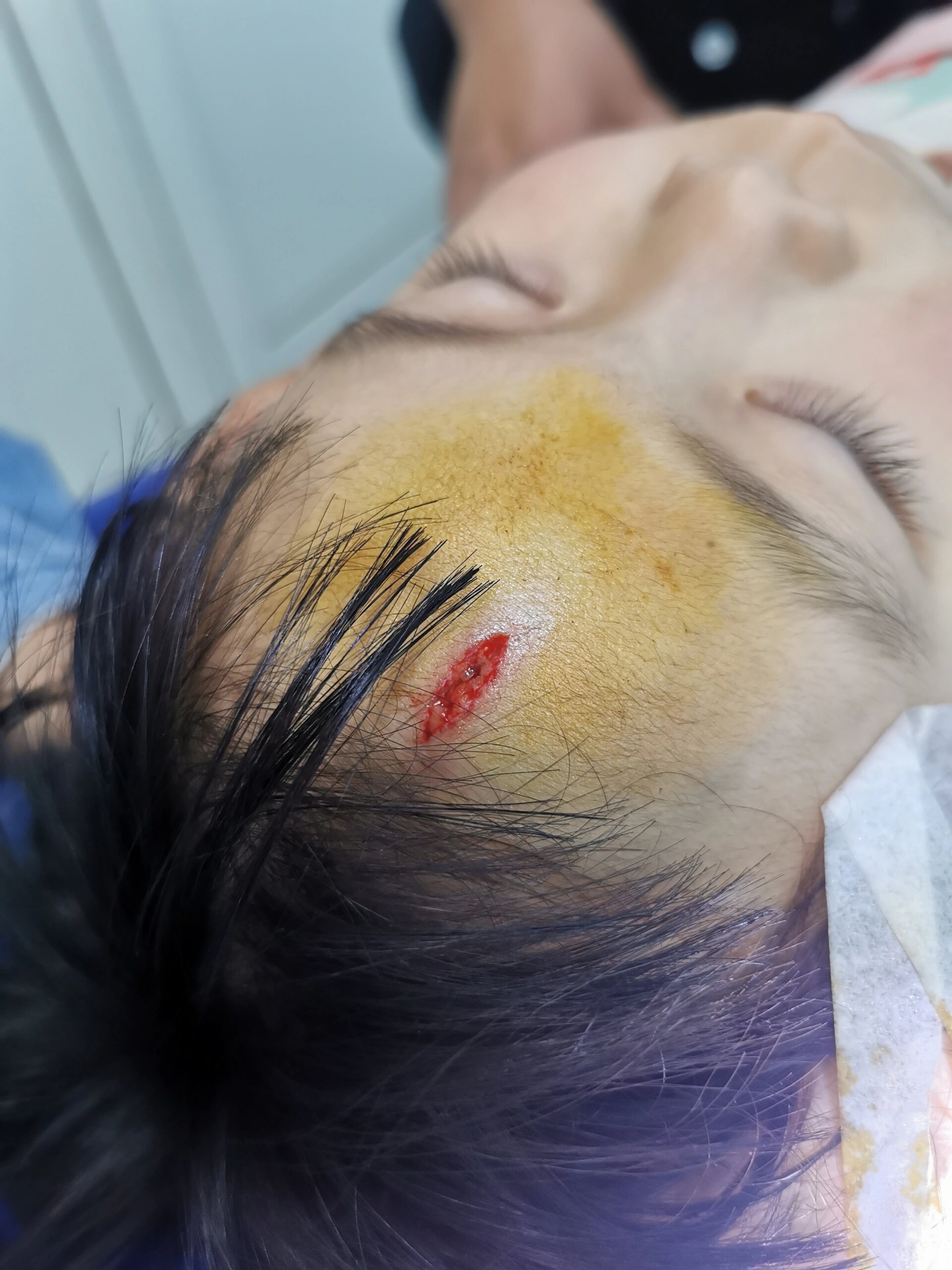 孩子在游乐场受伤,游乐场全责,该怎么理赔