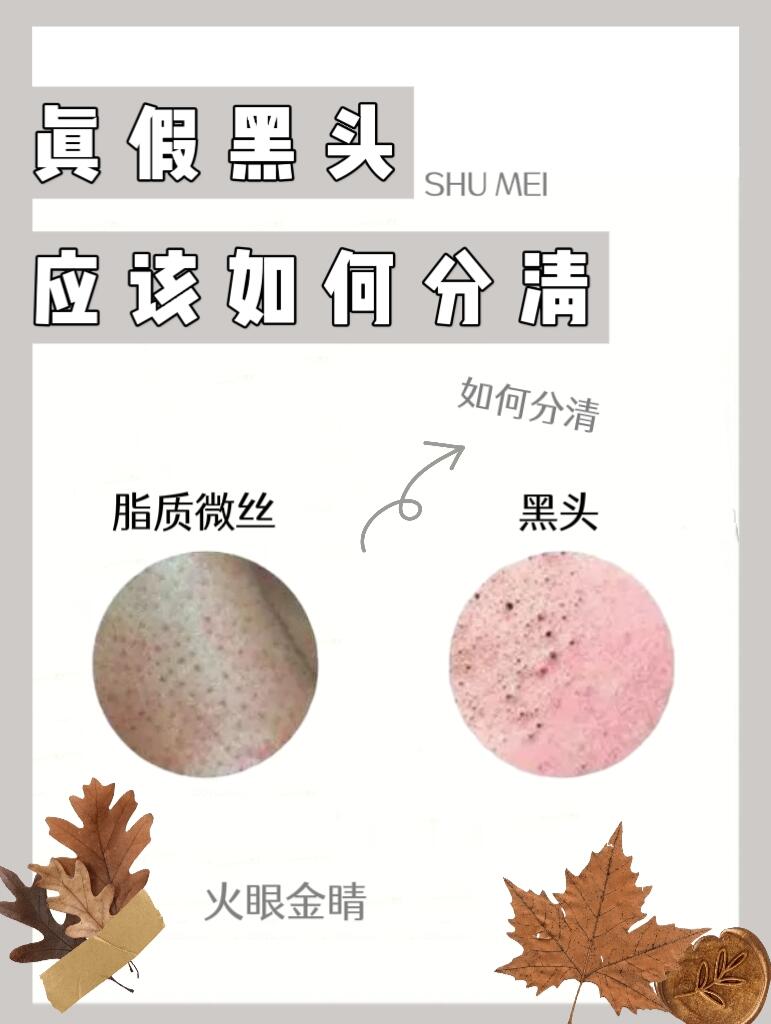 假黑头其实就是一般所说的脂质微丝73.