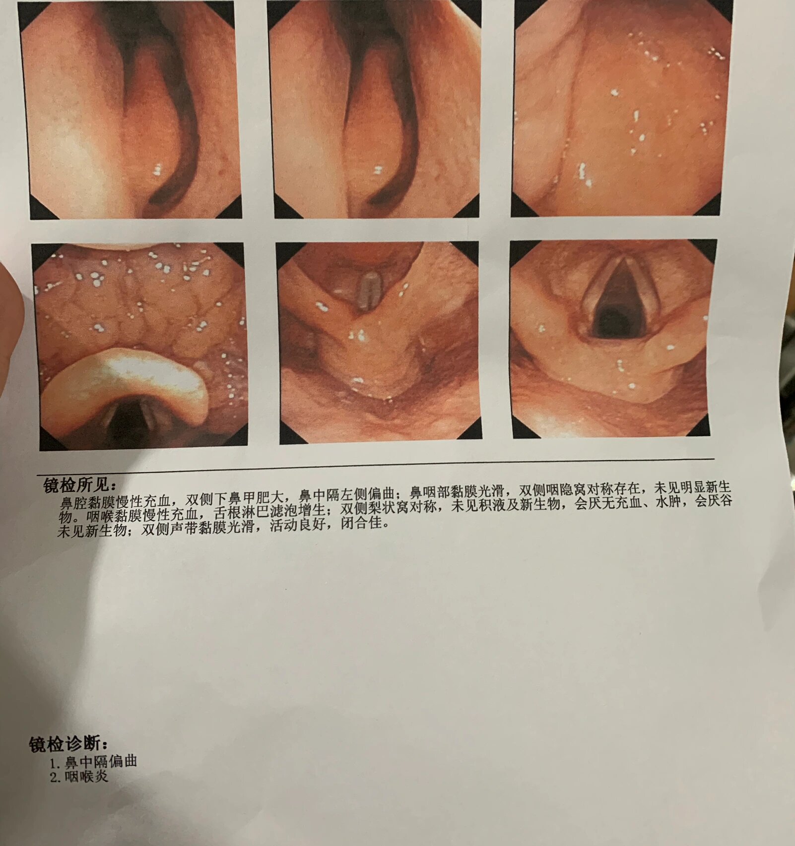 鼻咽镜多少钱一次图片