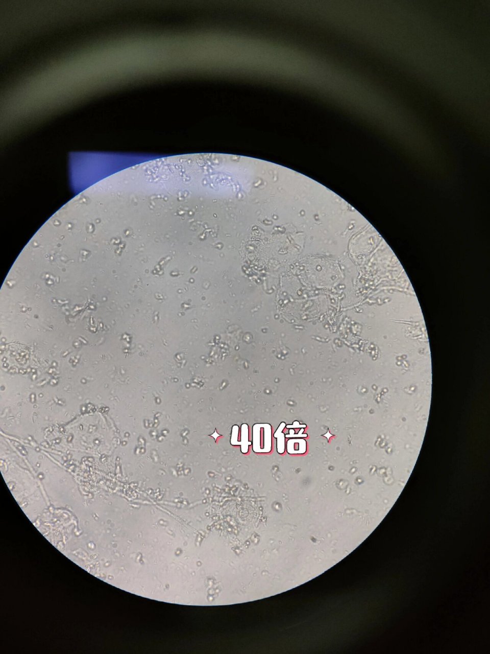 白带荧光之真菌孢子 真菌性阴道炎(念珠菌性阴道炎) 白带性状:白色