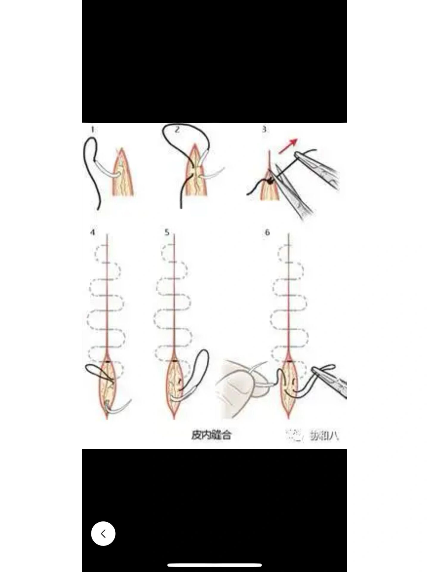 手术拆线图解图片