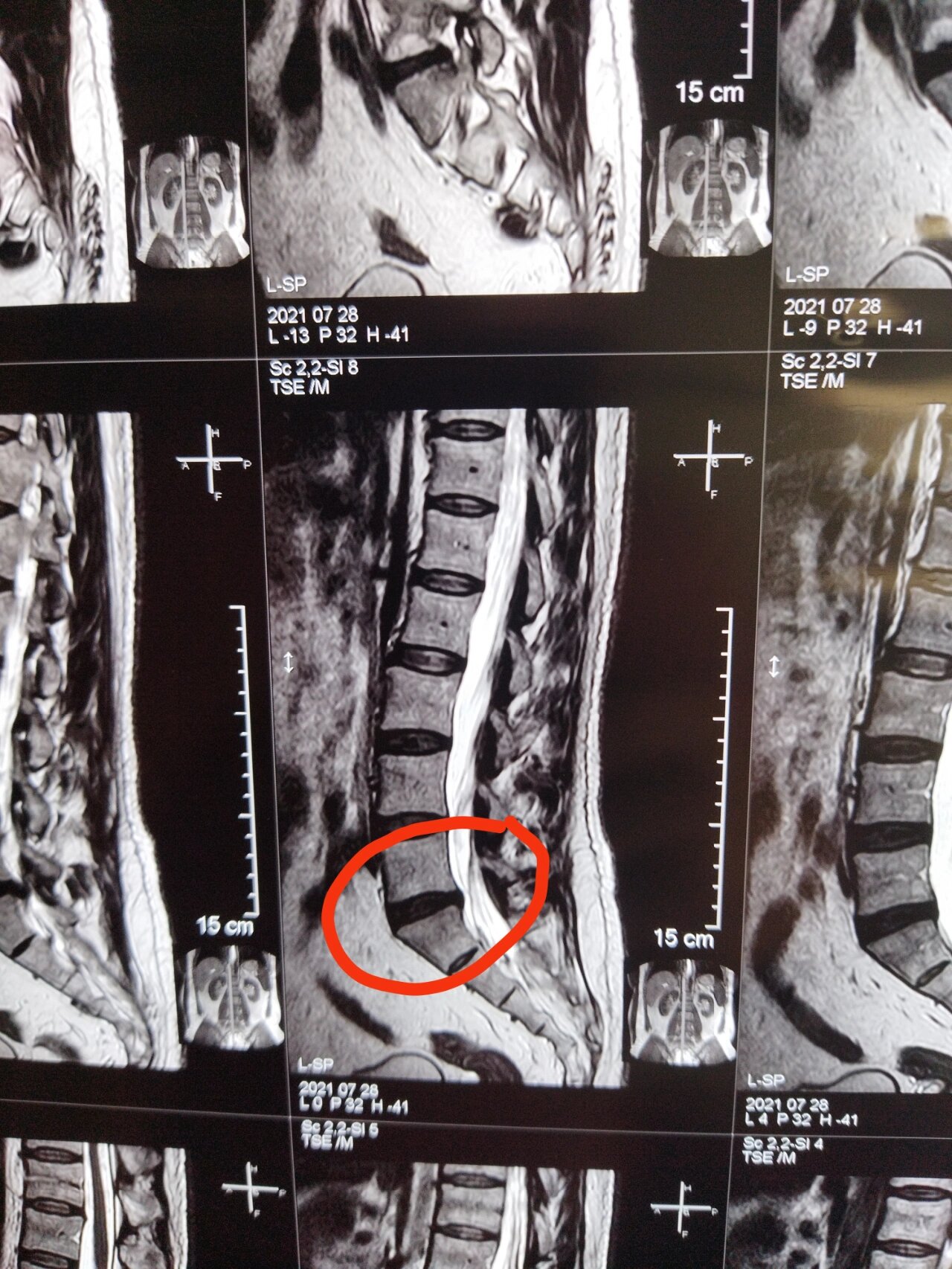 腰5骶1正常图像图片