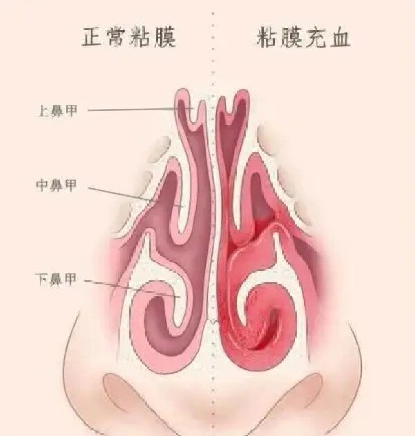 健康的鼻黏膜,不管白天,夜晚,都不会鼻塞