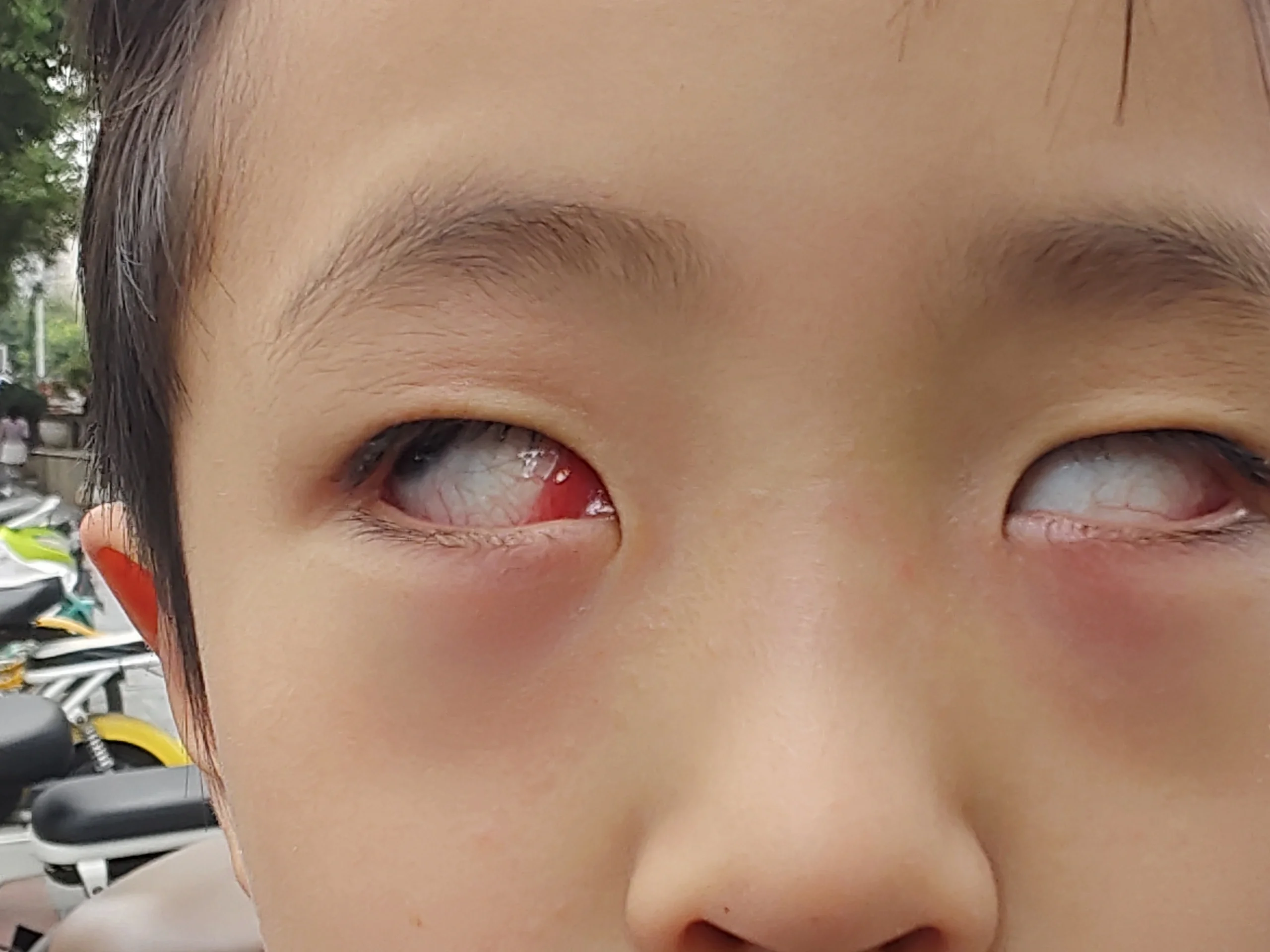 季节性过敏性结膜炎妈妈们求支招 季节性过敏性结膜炎 67肿么办,好