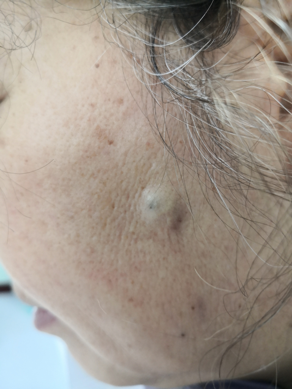 面部皮下囊肿.#手术##皮脂腺囊肿# 手术切除.