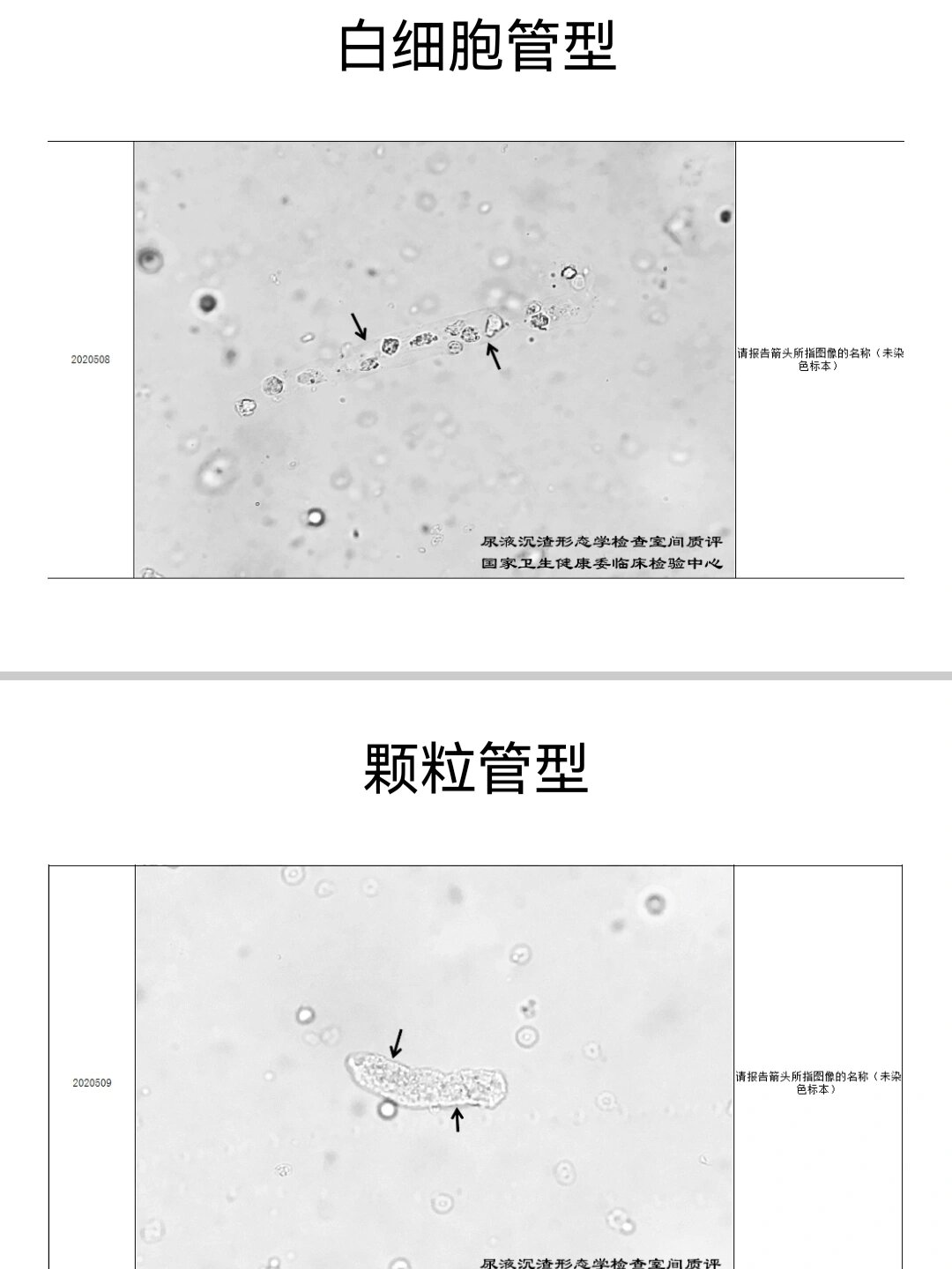 尿沉渣图谱结晶图片