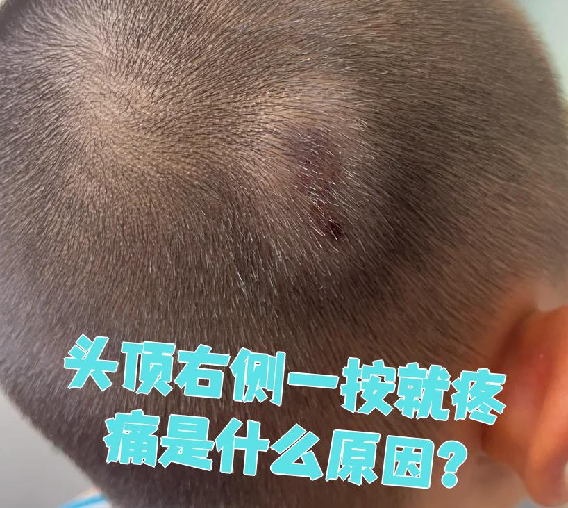 为什么头皮疼一摸就疼