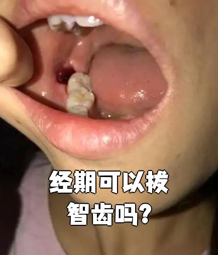 经期为什么不能拔牙