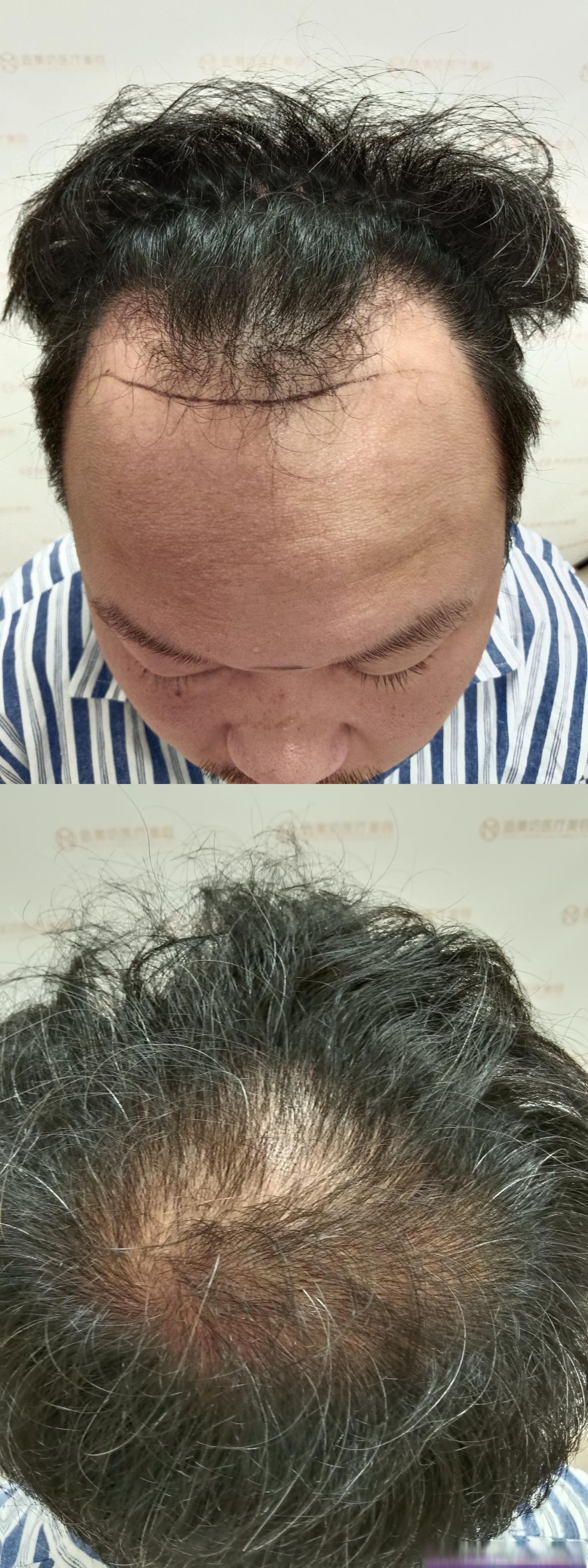 为什么植发的人不多 为什么植发的人不多