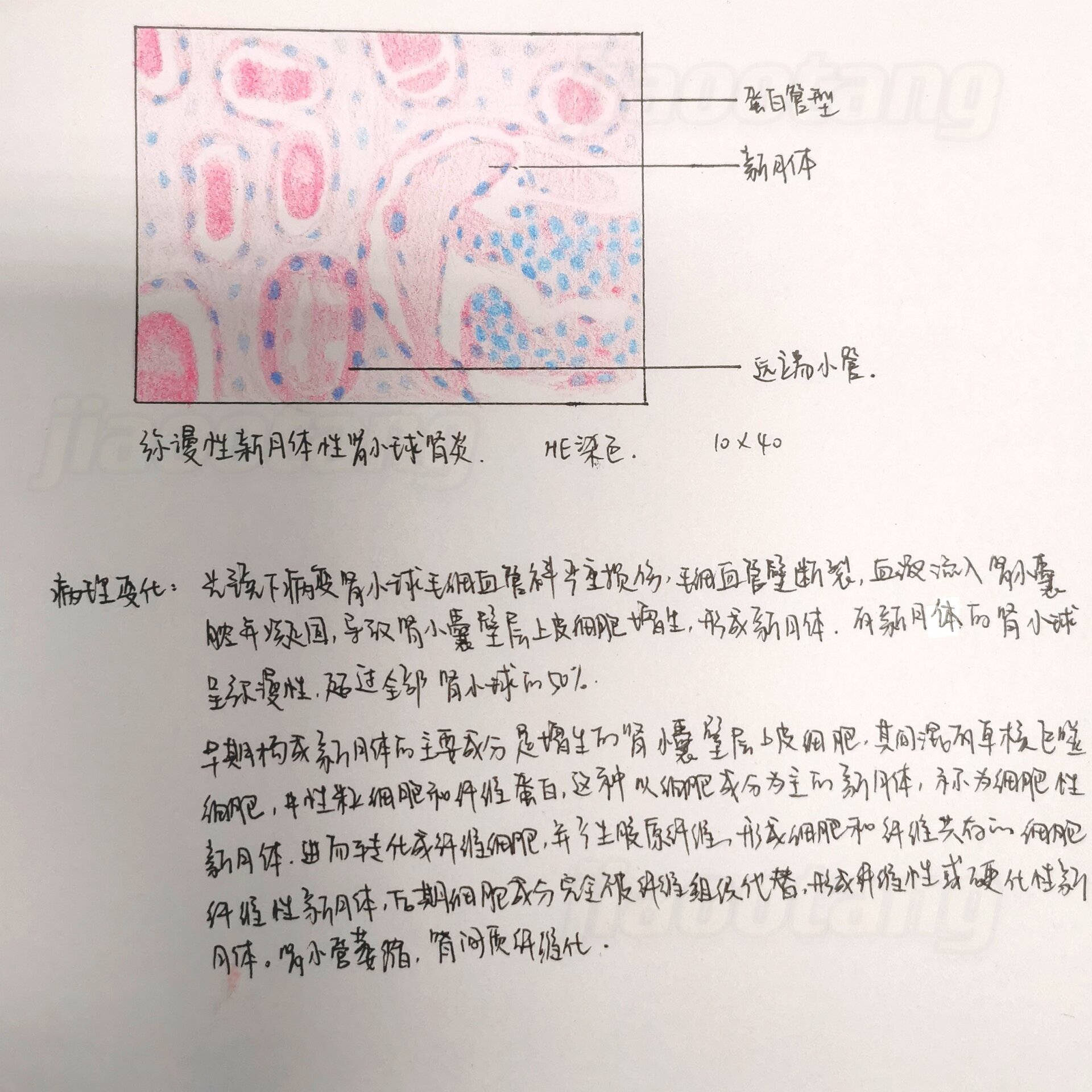 慢性肾炎红蓝铅笔绘图图片