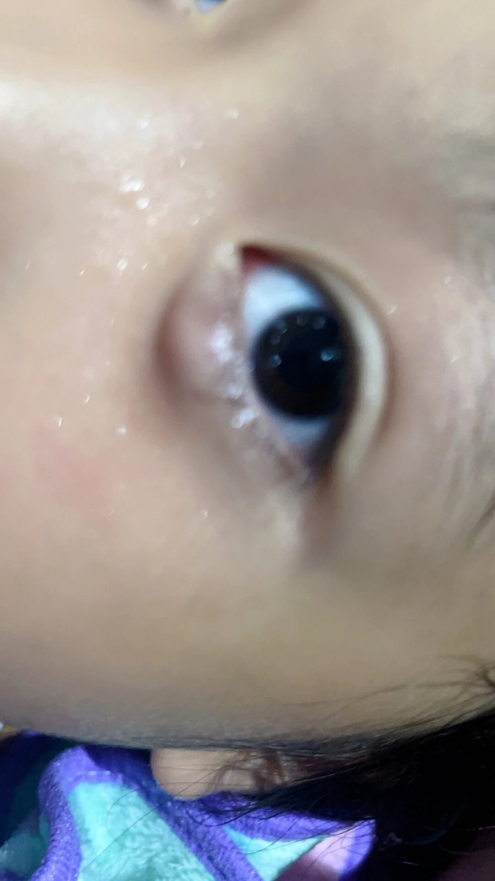 霰粒肿消除之路1 那是一个周末的早晨,起床,发现娃的眼睛👁️有点
