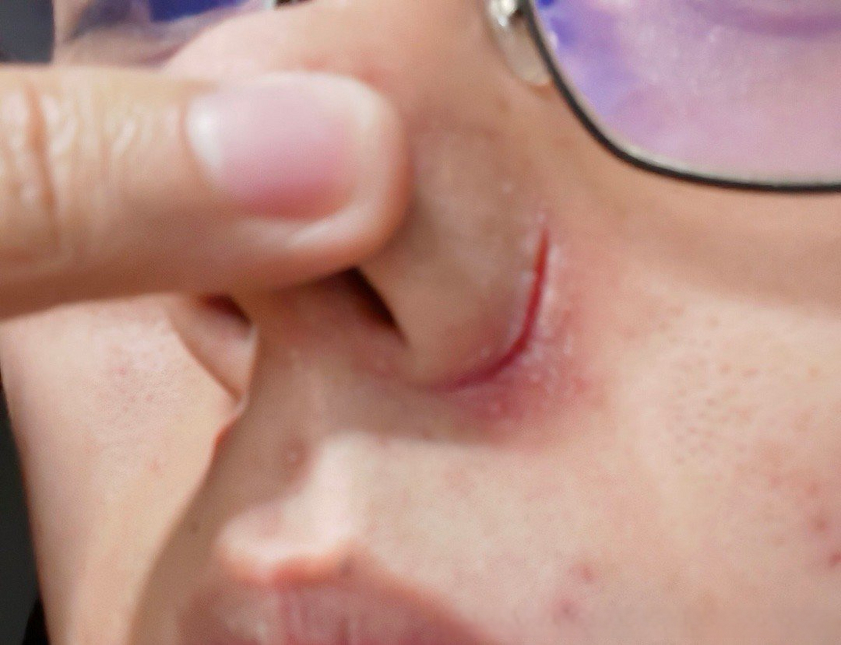 鼻翼两侧(与面部相交处)反复开裂,愈合后依然会发作.