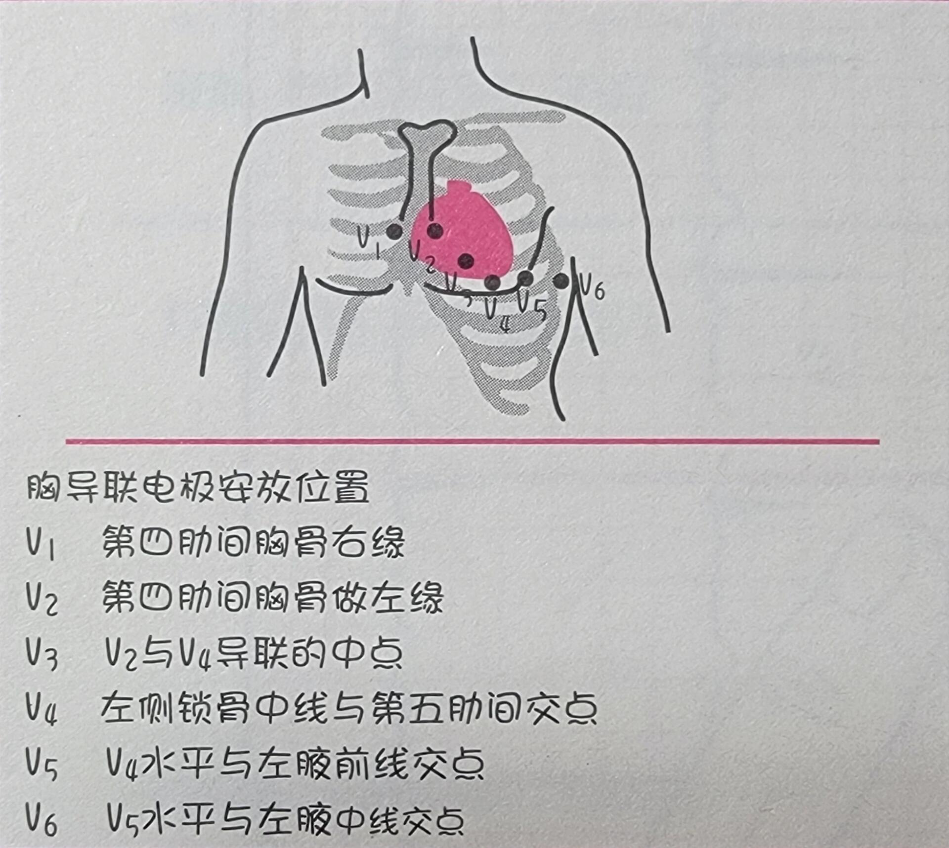 心电图安放位置图片