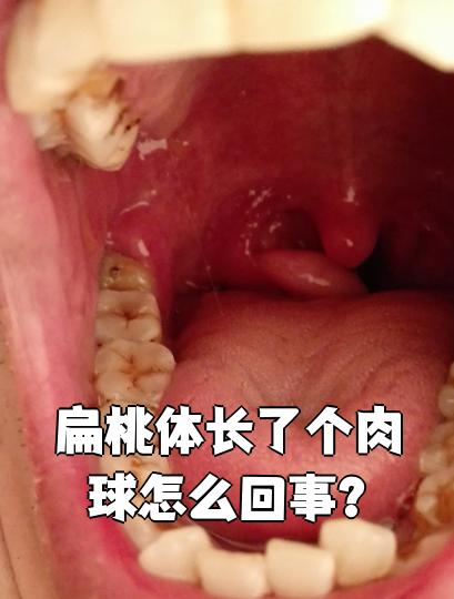 扁桃体长了个肉球怎么回事?