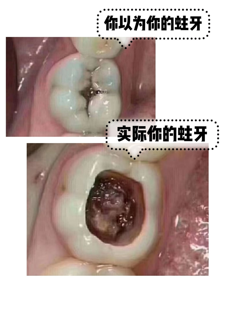 你以为你的蛀牙vs真实的蛀牙情况 有小伙伴跟我说,去补牙,牙齿还被磨