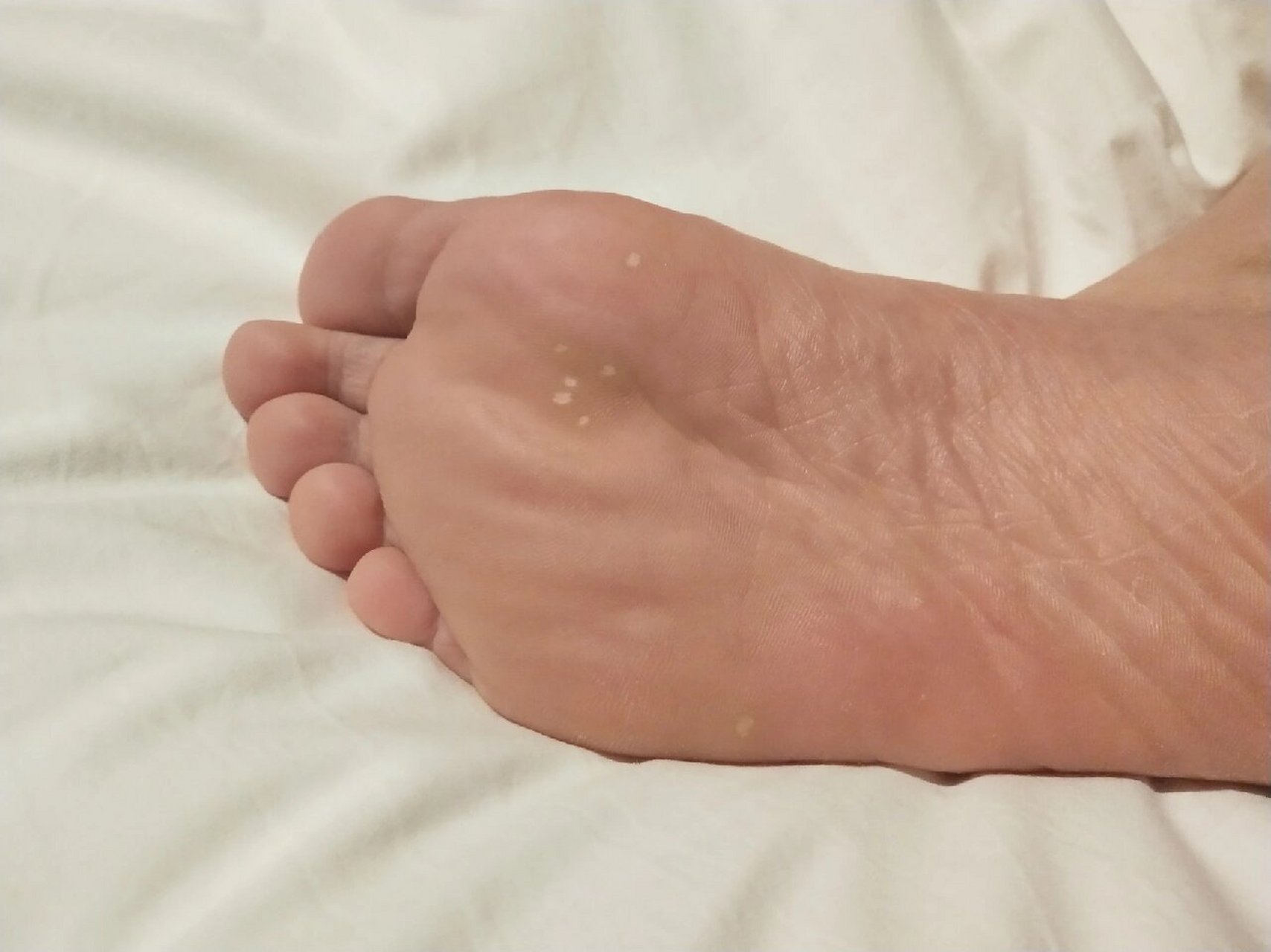 01右脚脚底长了几个白色的硬的疙瘩 我的右脚之前偶然发现有几个