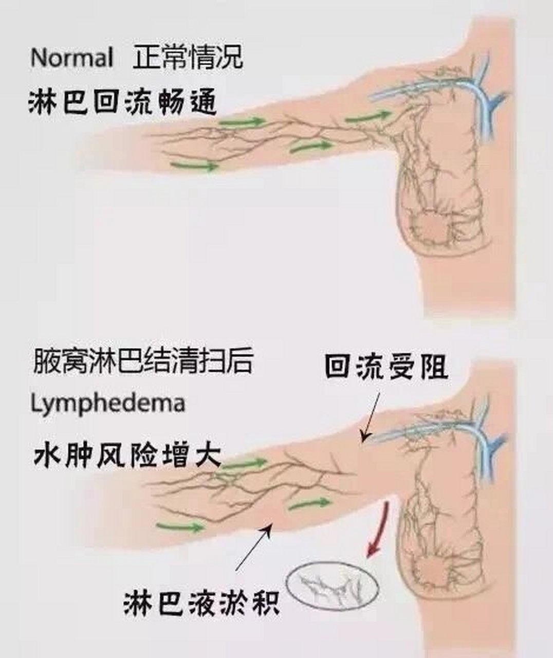 淋巴引流途径图片图片