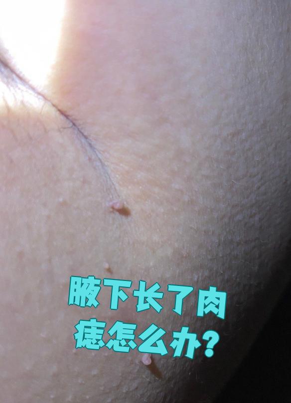 腋下长肉痣先别慌,常见的有色素痣和丝状疣两种