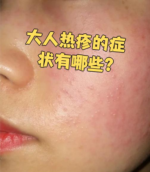 的主要症状包括红斑,丘疱疹和瘙痒