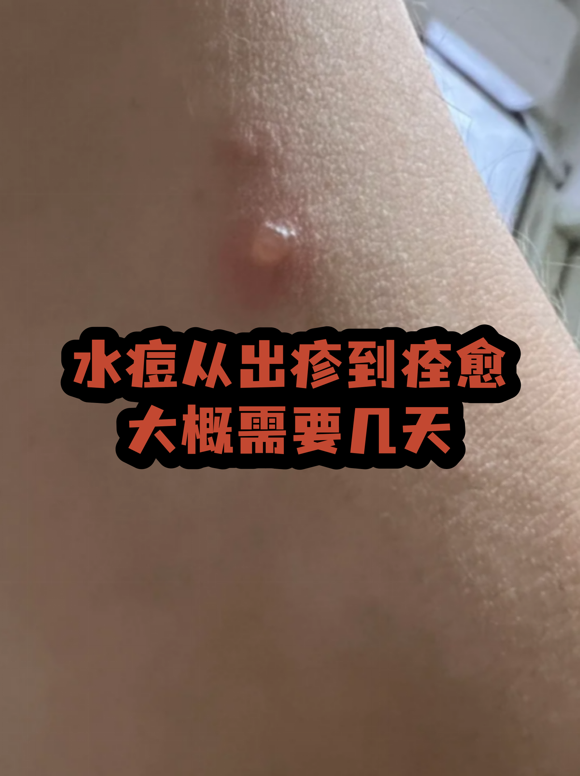  最近的病毒感染有什么症状几天能好转(病毒感染一般几天不传染)