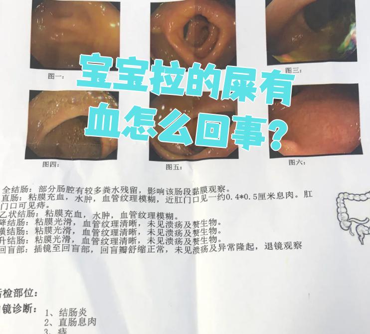 为什么大便会拉出血