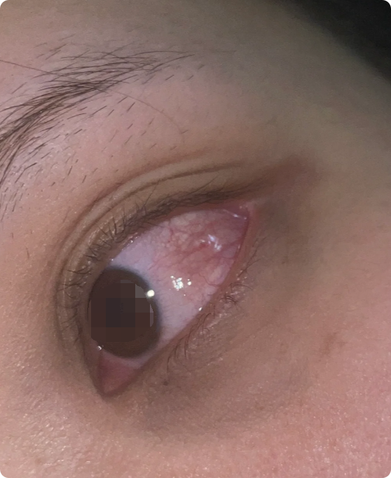 第一,吃太多辛辣食物会引发身体炎症反应,导致角膜出现水泡