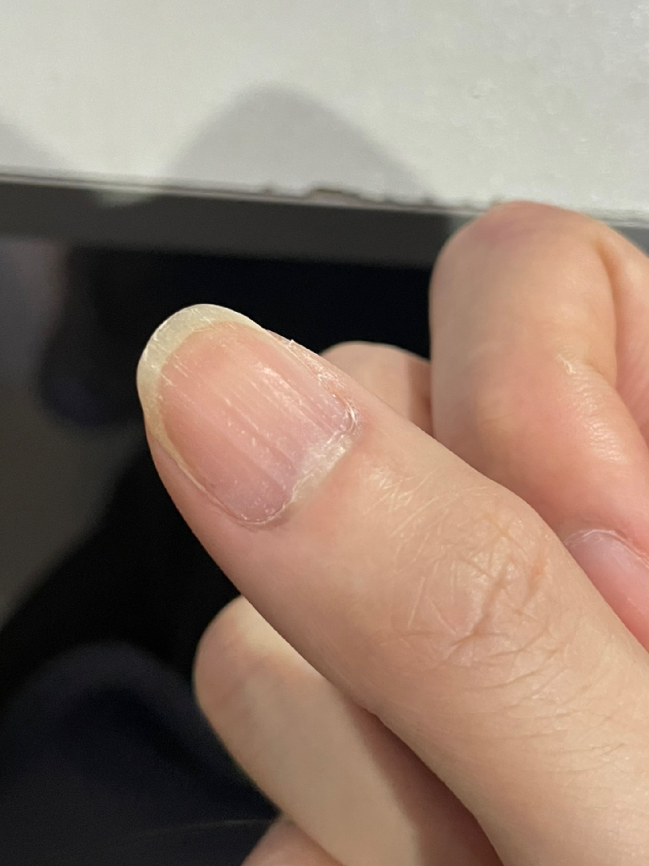 手指甲表面很多竖条纹 摸上去凹凸不平,一棱一棱的,还会泛白是啥原因