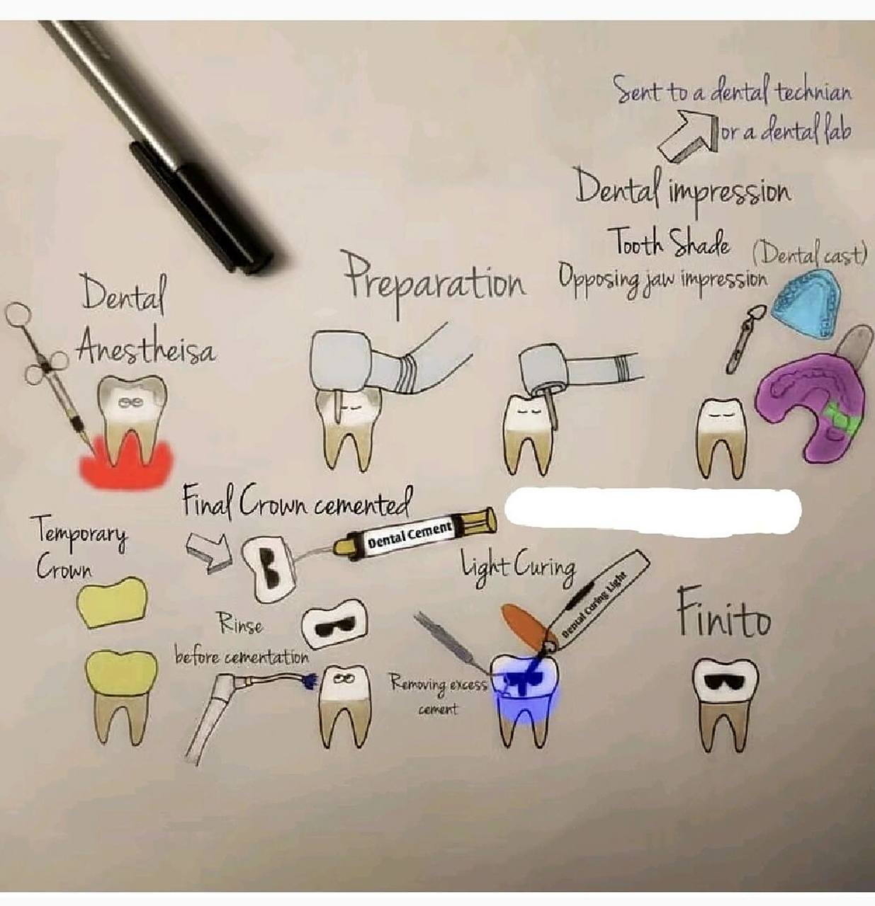 牙体预备(备牙)流程