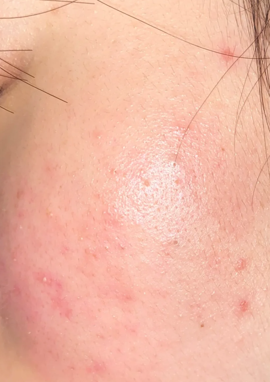 这种情况通常是因为面膜里的某些成分刺激皮肤,引发过敏反应