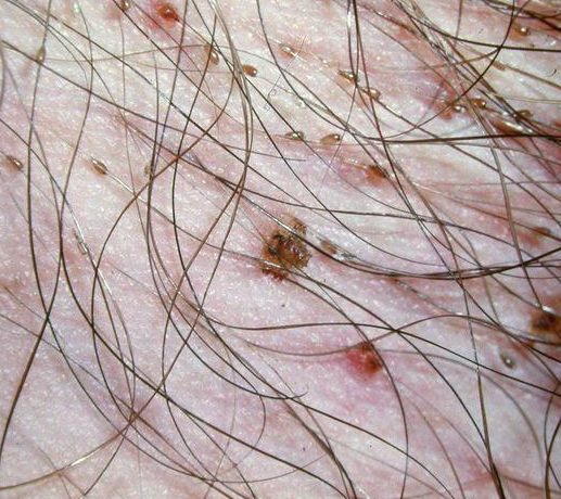 阴虱是寄生在人体毛发的寄生虫,长度约1