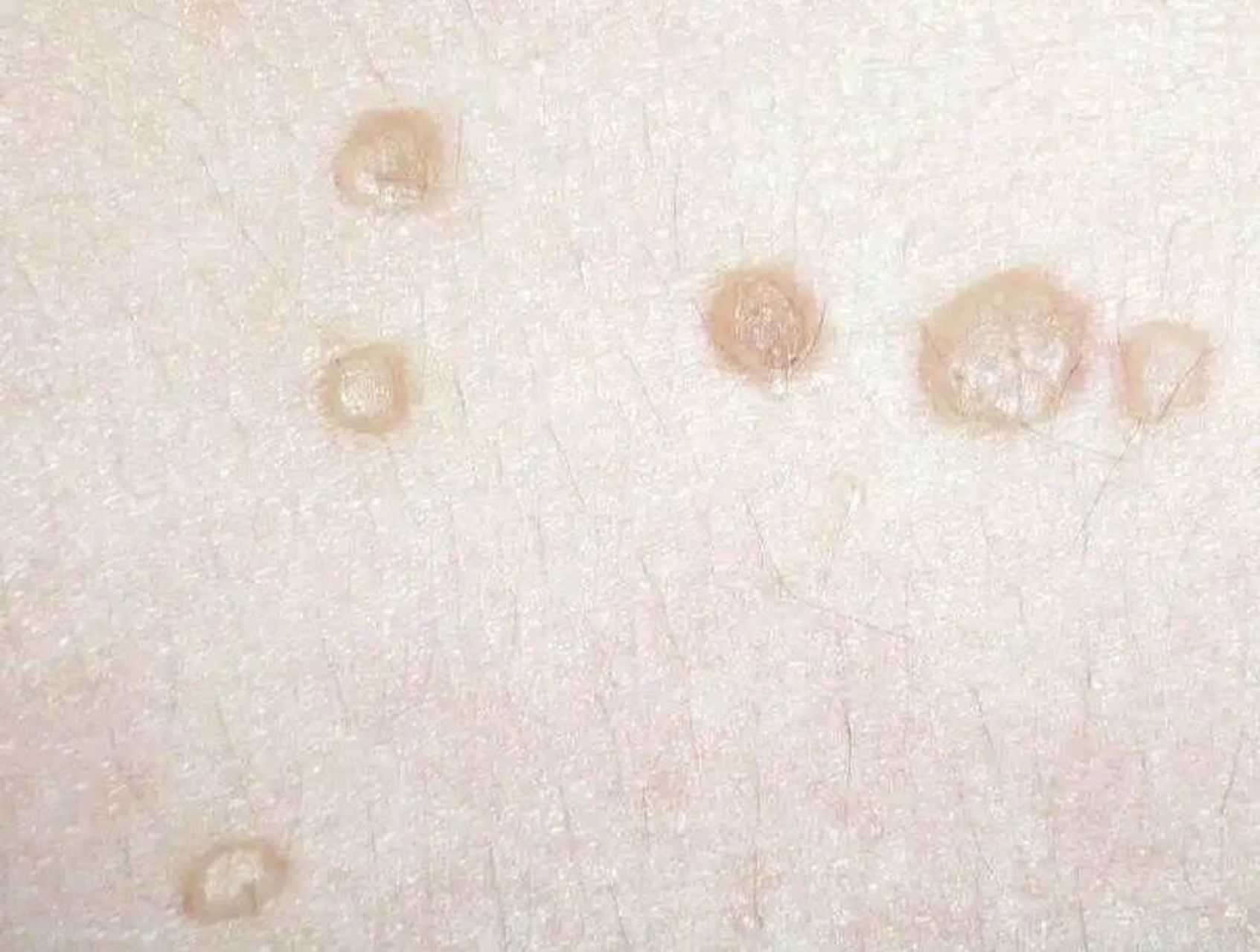 如何判断是不是得了扁平疣 扁平疣在现在生活中也算是一种比较常见的