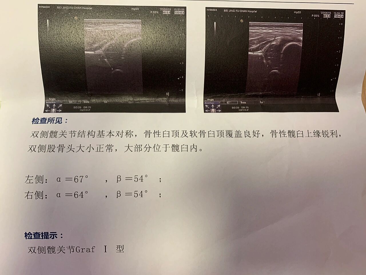 新生儿髋关节发育graf i型 我想问一下大家,42天宝宝髋关节这个角度是