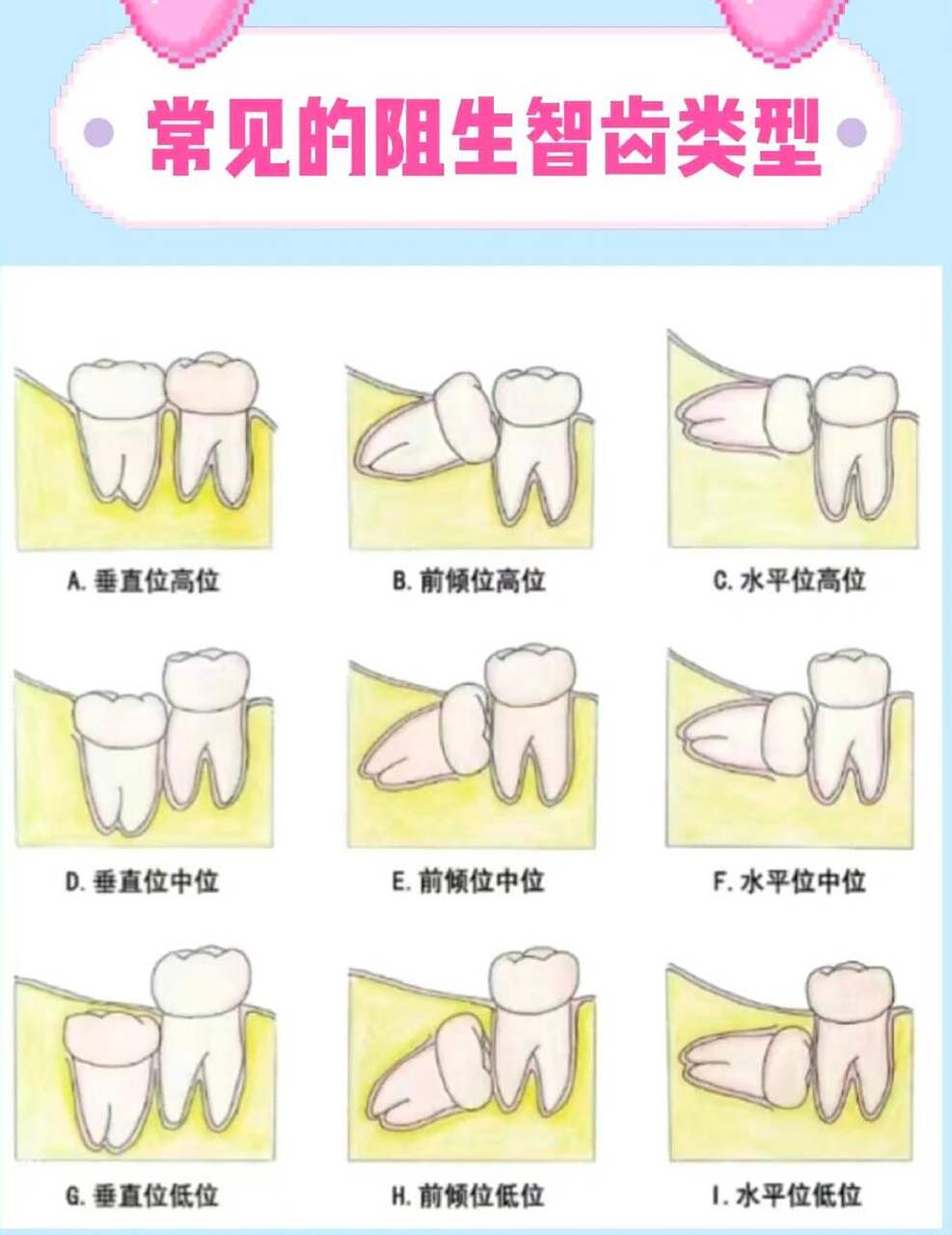 一天一个口腔小知识:阻生智齿 大家的智齿是正位生长吗