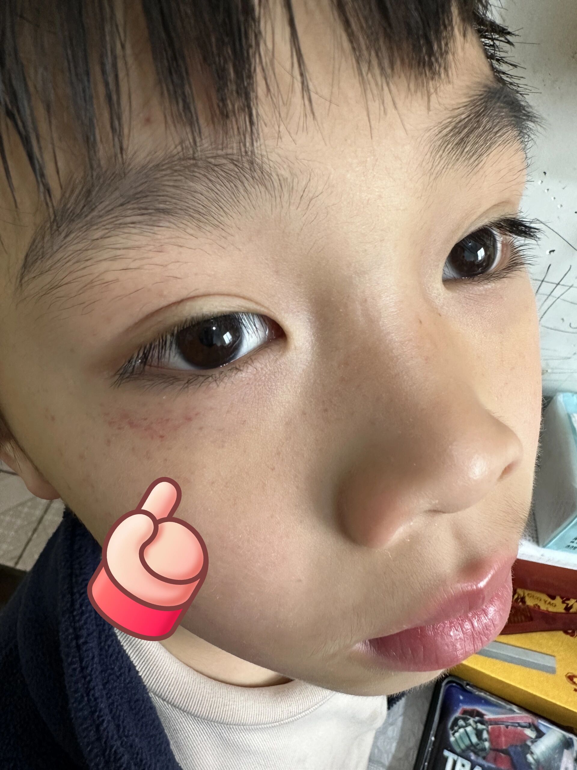 孩子脸上的小红点是啥?