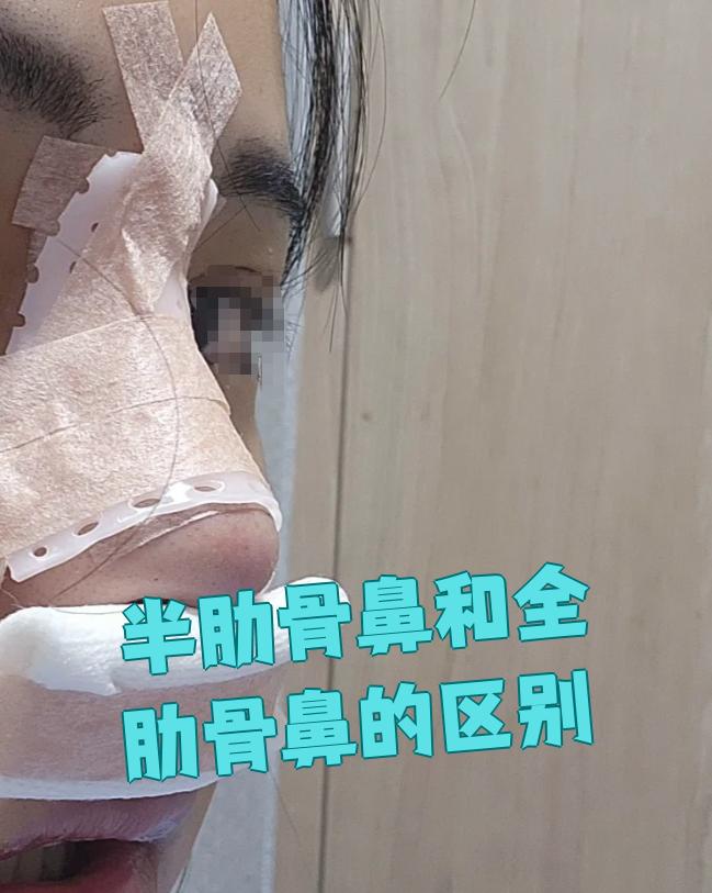 半肋骨鼻只用肋软骨做鼻尖塑形,鼻背部分要靠假体材料填充,比如硅胶或