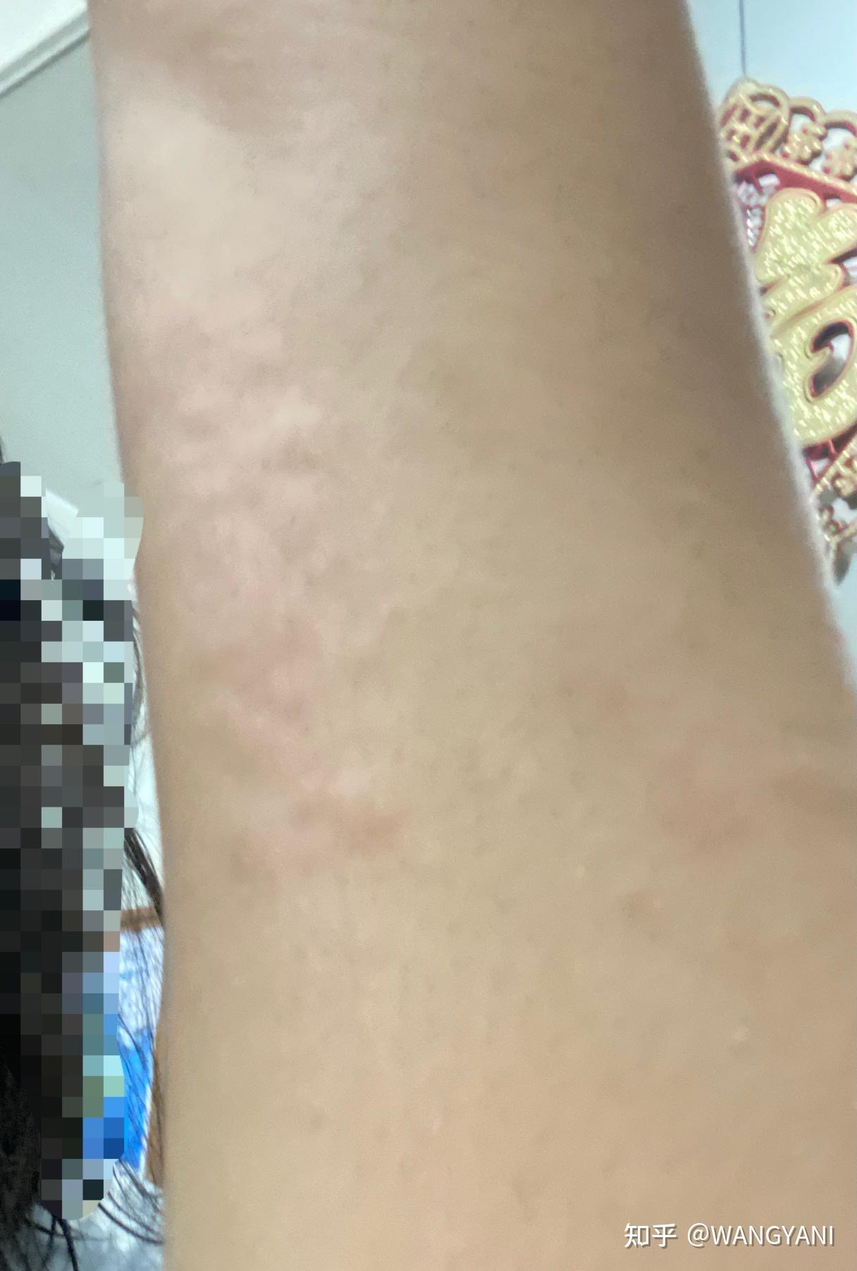 海鲜过敏是怎样一种体验