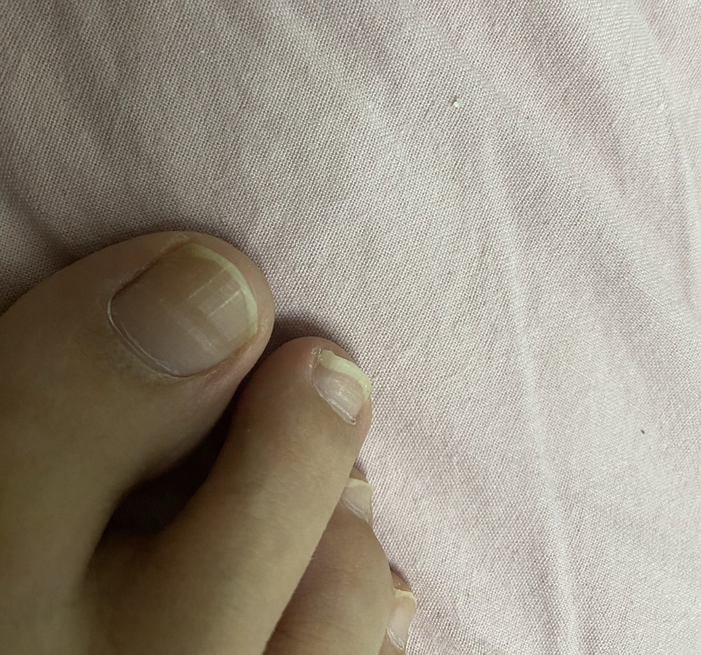 脚指甲出现横纹凹陷是怎么回事呀,有相同情况的吗